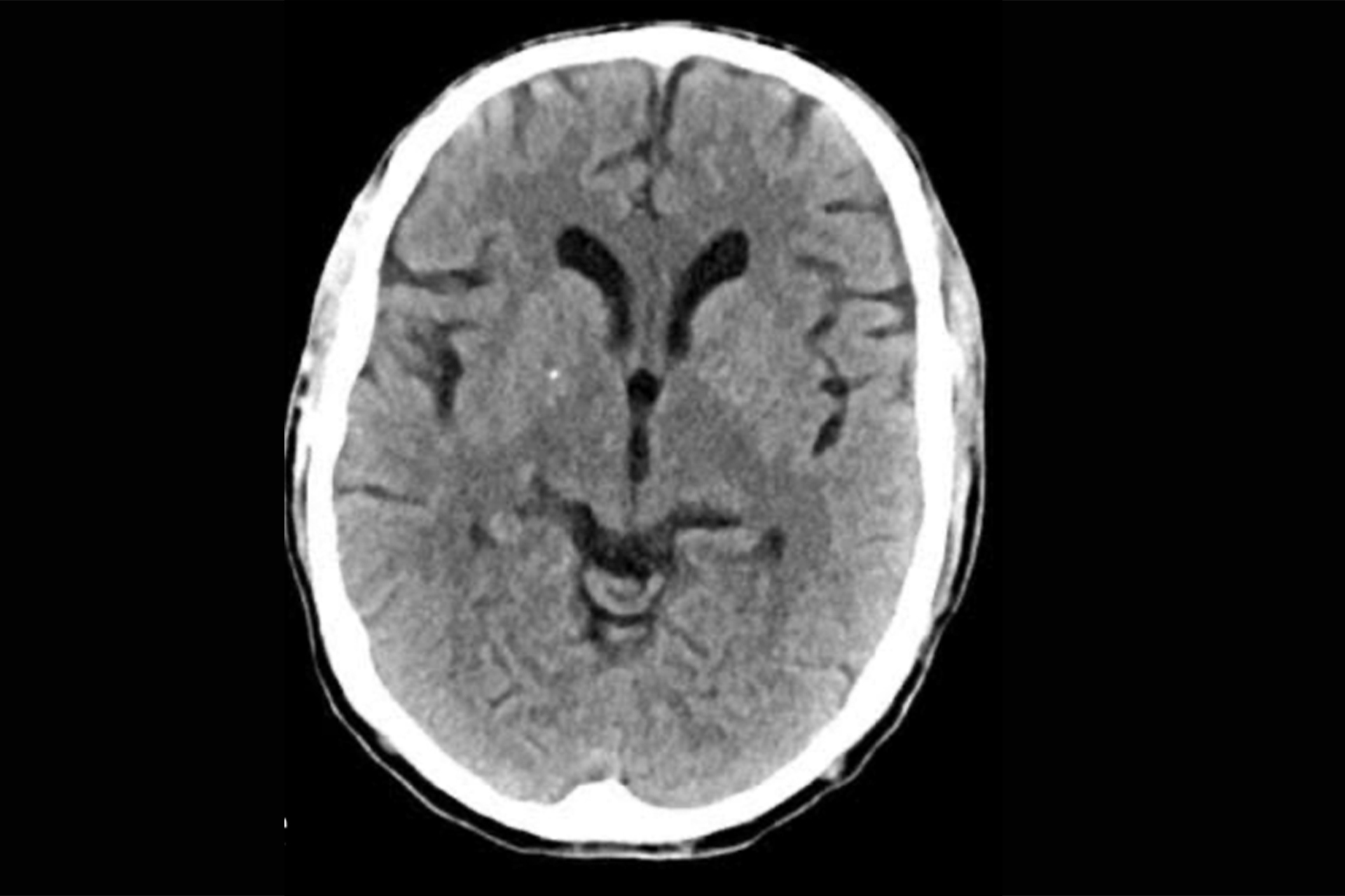 Cerebral